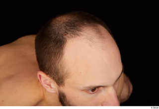 Orest bald hair 0008.jpg